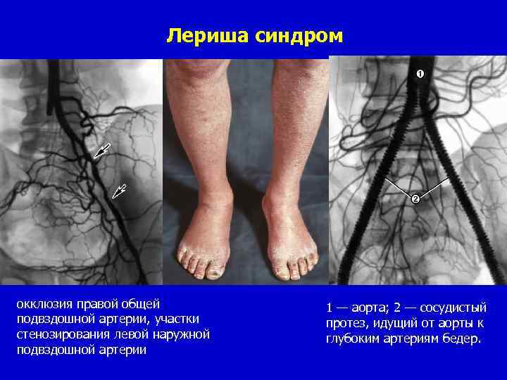 Лимфовенозная недостаточность нижних конечностей фото