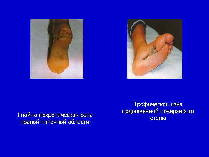 Трофическая язва нижних конечностей карта вызова