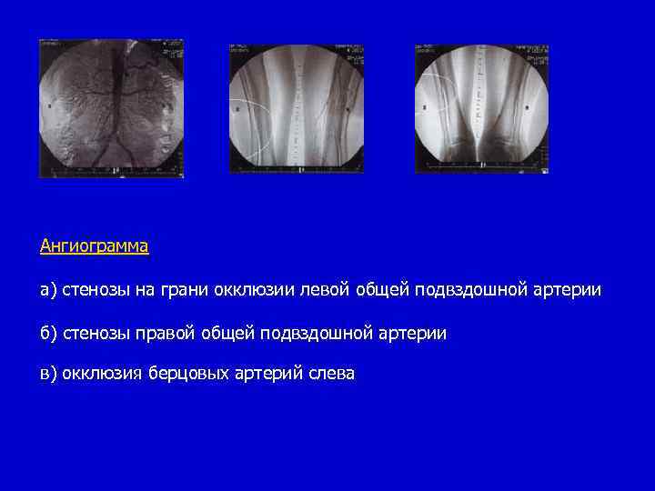 Окклюзия справа. Окклюзия общей подвздошной артерии. Окклюзия левой подвздошной артерии. Окклюзия правой подвздошной артерии.