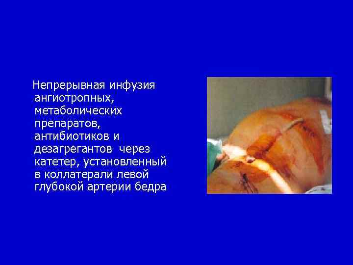  Непрерывная инфузия ангиотропных, метаболических препаратов, антибиотиков и дезагрегантов через катетер, установленный в коллатерали
