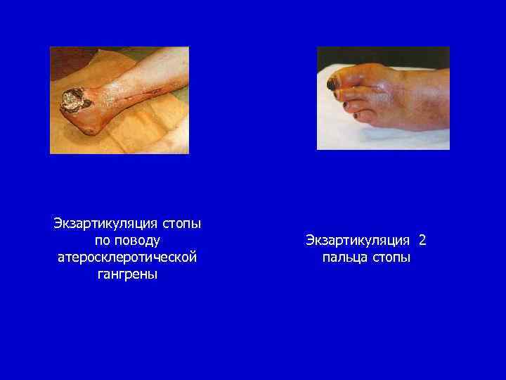 Экзартикуляция стопы по поводу атеросклеротической гангрены Экзартикуляция 2 пальца стопы 