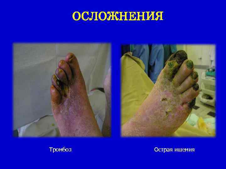 ОСЛОЖНЕНИЯ Тромбоз Острая ишемия 