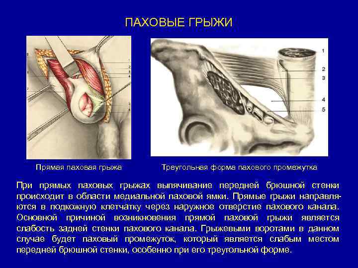 ПАХОВЫЕ ГРЫЖИ Прямая паховая грыжа Треугольная форма пахового промежутка При прямых паховых грыжах выпячивание