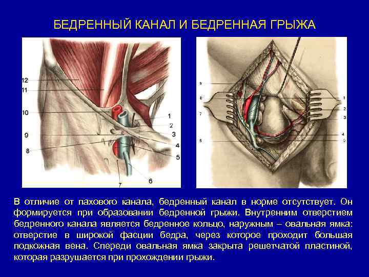 БЕДРЕННЫЙ КАНАЛ И БЕДРЕННАЯ ГРЫЖА В отличие от пахового канала, бедренный канал в норме