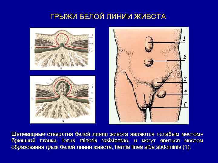 Грыжи передней брюшной стенки презентация