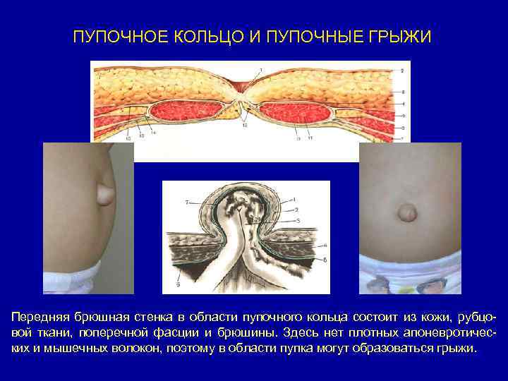 ПУПОЧНОЕ КОЛЬЦО И ПУПОЧНЫЕ ГРЫЖИ Передняя брюшная стенка в области пупочного кольца состоит из