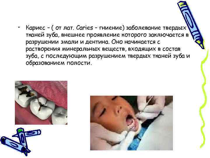  • Кариес – ( от лат. Caries – гниение) заболевание твердых тканей зуба,