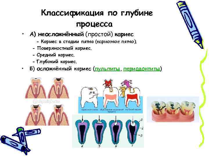 Классификация по глубине процесса • А) неосложнённый (простой) кариес - Кариес в стадии пятна