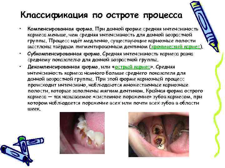 Классификация по остроте процесса • • • Компенсированная форма. При данной форме средняя интенсивность