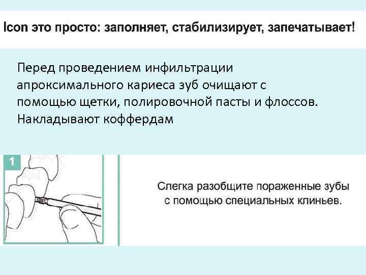 Перед проведением инфильтрации апроксимального кариеса зуб очищают с помощью щетки, полировочной пасты и флоссов.