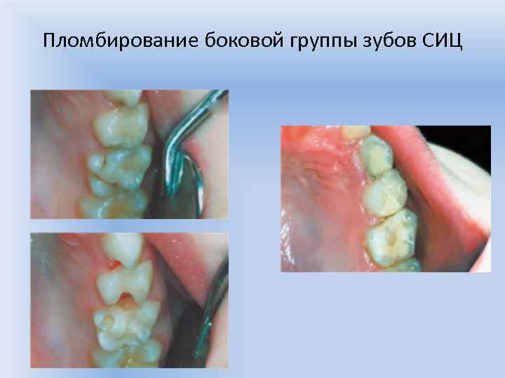 Пломбировочные материалы в детской стоматологии презентация