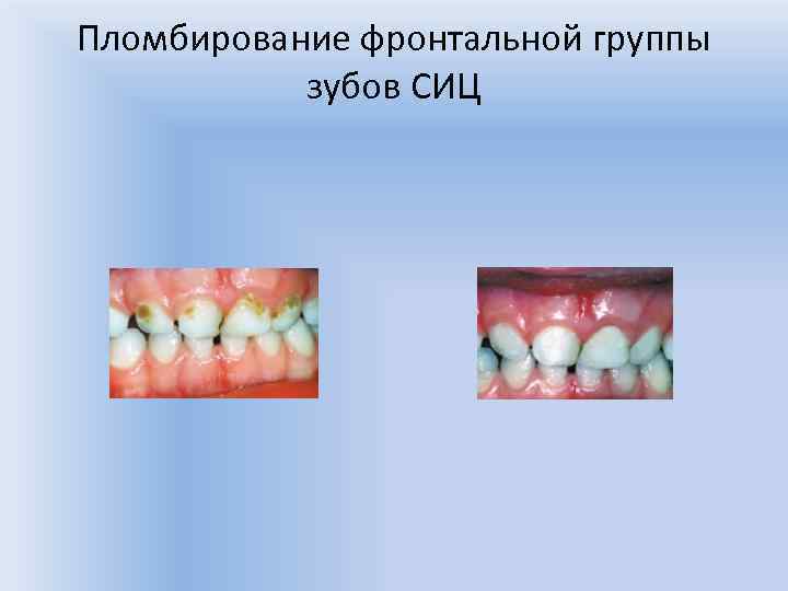 Пломбирование фронтальной группы зубов СИЦ 