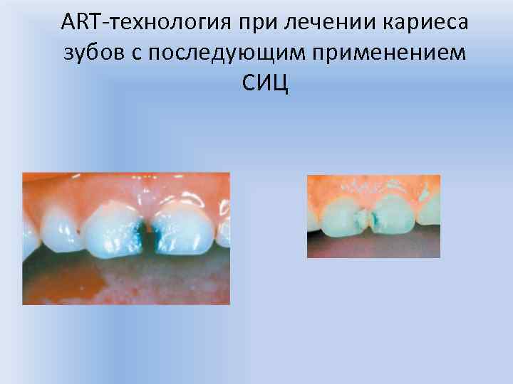 ART-технология при лечении кариеса зубов с последующим применением СИЦ 