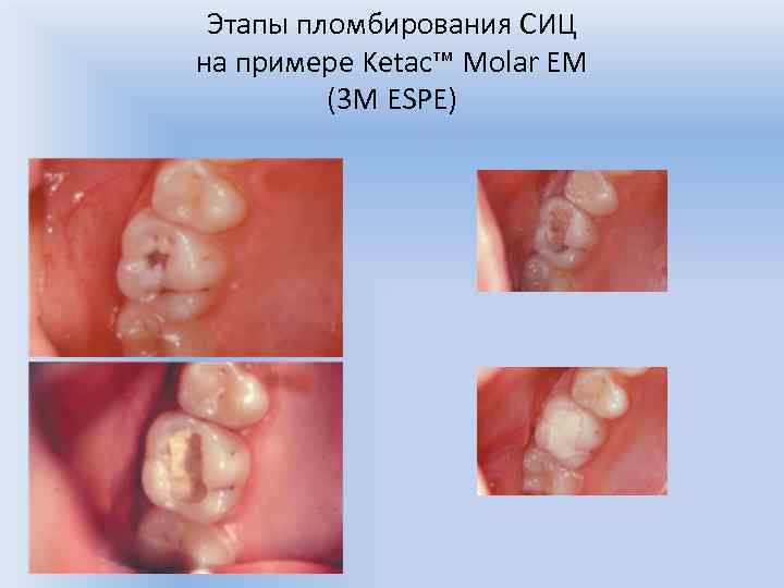 Этапы пломбирования СИЦ на примере Ketac™ Molar EM (3 M ESPE) 