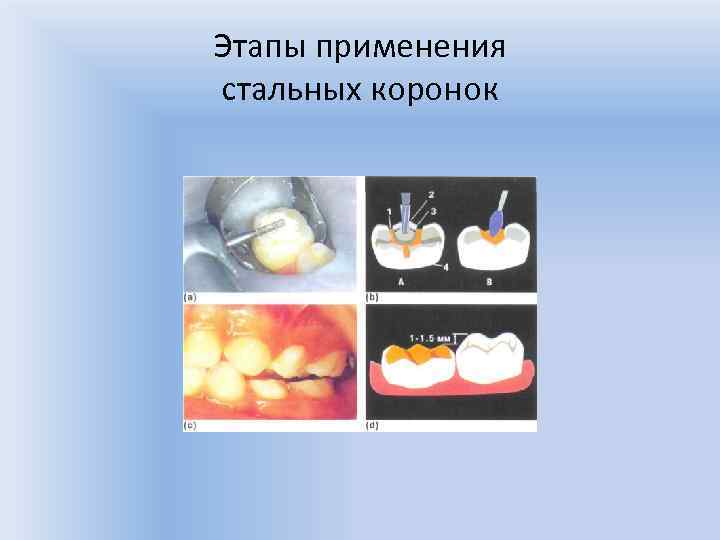 Этапы применения стальных коронок 