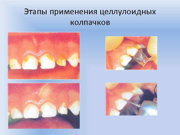 Этапы применения целлулоидных колпачков 