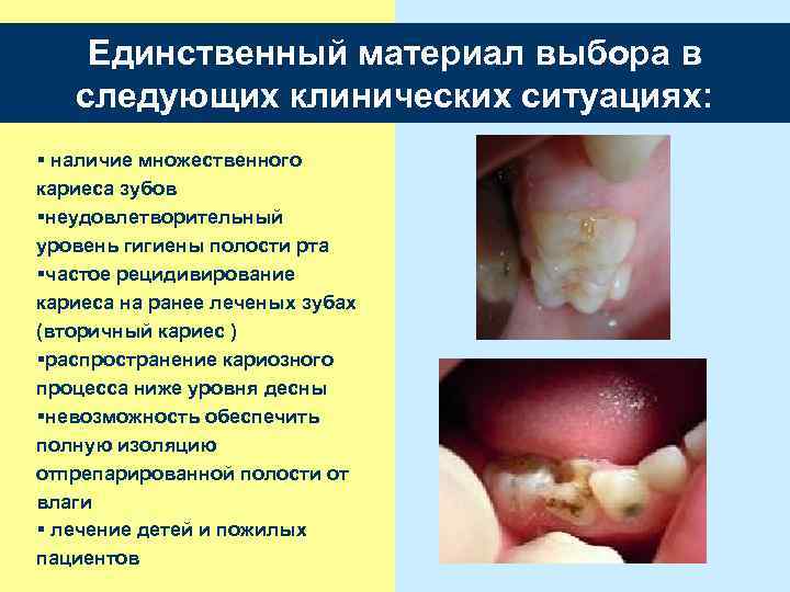Единственный материал выбора в следующих клинических ситуациях: § наличие множественного кариеса зубов §неудовлетворительный уровень