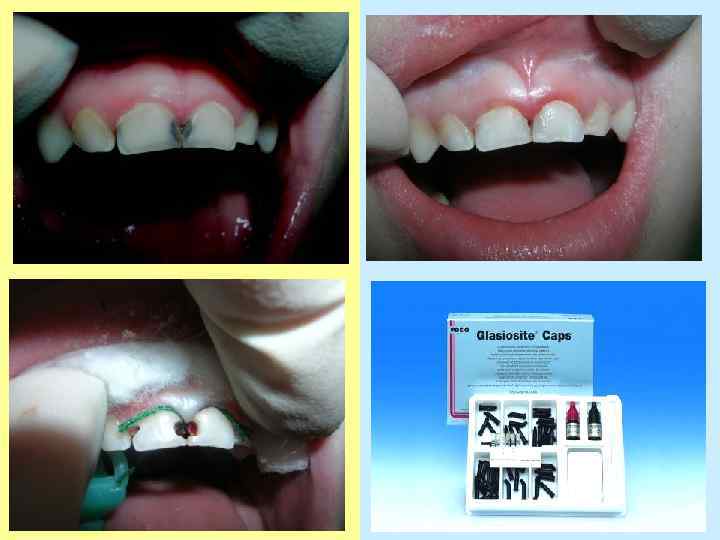 Материалы применяемые для лечения молочных зубов