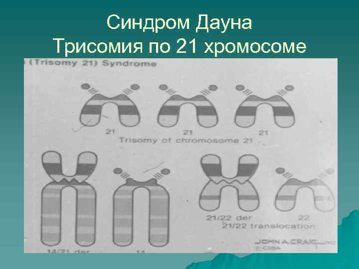 Синдром Дауна Трисомия по 21 хромосоме 