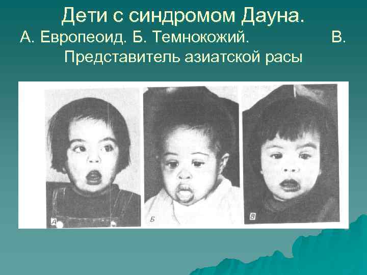 Дети с синдромом Дауна. А. Европеоид. Б. Темнокожий. Представитель азиатской расы В. 