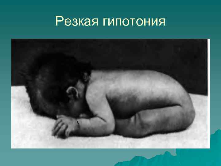 Резкая гипотония 