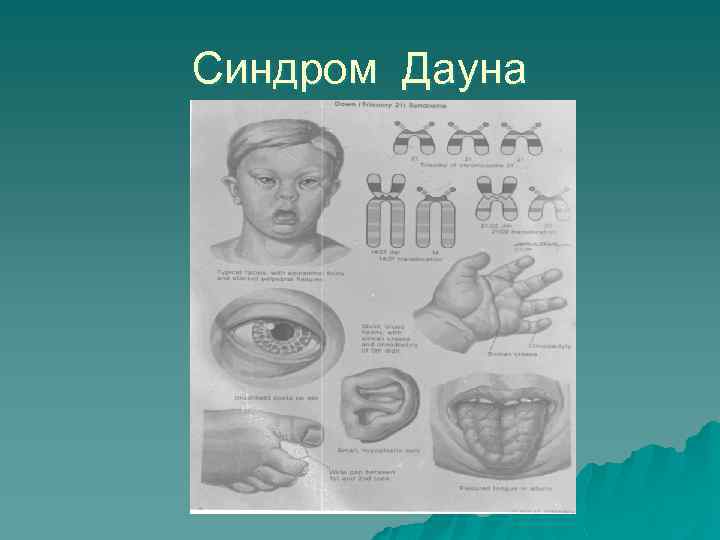 Синдром Дауна 
