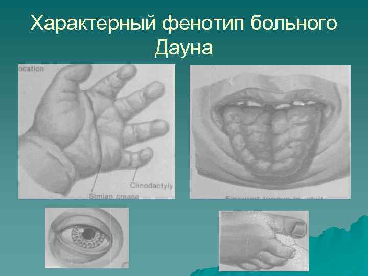 Характерный фенотип больного Дауна 