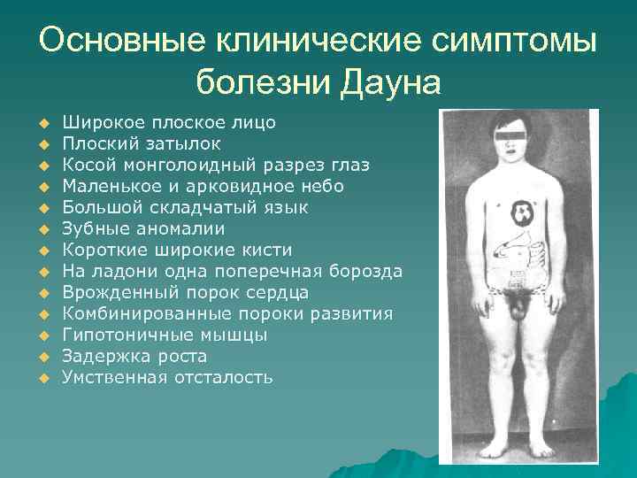 Основные клинические симптомы болезни Дауна u u u u Широкое плоское лицо Плоский затылок