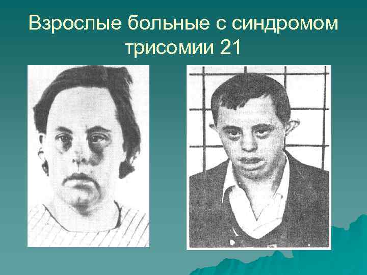 Взрослые больные с синдромом трисомии 21 