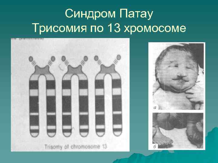Синдром Патау Трисомия по 13 хромосоме 