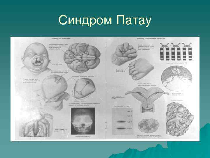 Синдром Патау 