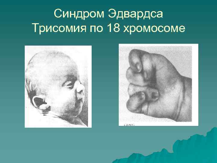 Синдром Эдвардса Трисомия по 18 хромосоме 