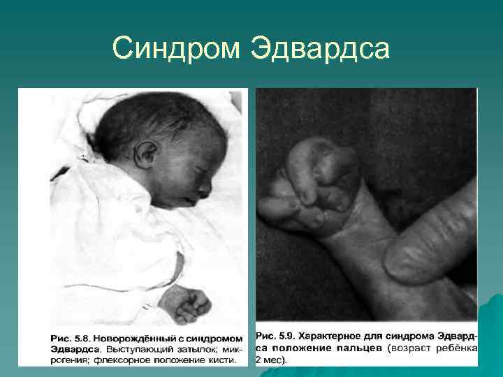 Синдром Эдвардса 