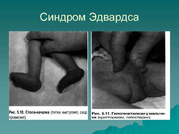 Синдром Эдвардса 