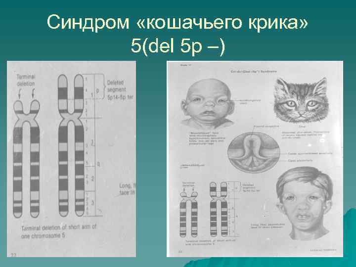 Синдром «кошачьего крика» 5(del 5 р –) 