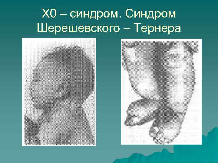 Х 0 – синдром. Синдром Шерешевского – Тернера 