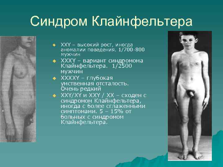 Синдром Клайнфельтера u u д ХXY – высокий рост, иногда аномалии поведения. 1/700 -800
