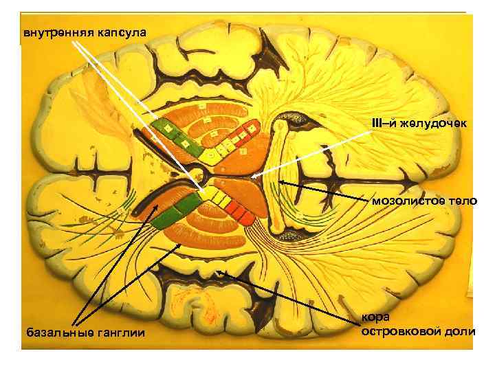 внутренняя капсула III–й желудочек мозолистое тело базальные ганглии кора островковой доли 