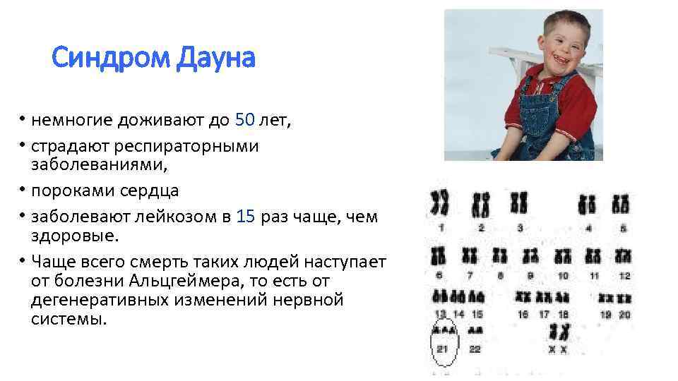 Синдром Дауна • немногие доживают до 50 лет, • страдают респираторными заболеваниями, • пороками