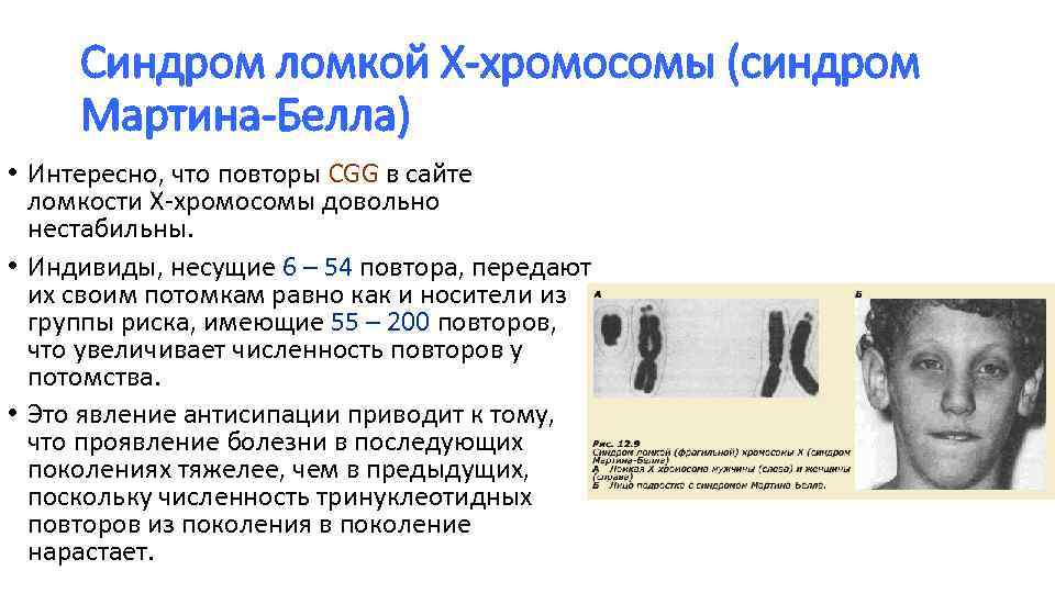 Синдром ломкой хромосомы