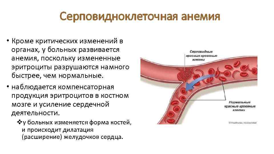 Серповидноклеточная анемия • Кроме критических изменений в органах, у больных развивается анемия, поскольку измененные