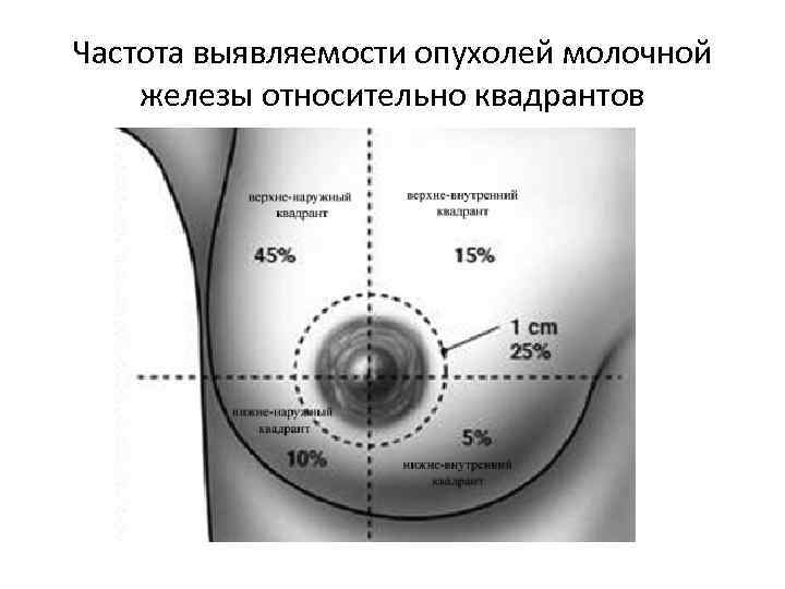 Частота выявляемости опухолей молочной железы относительно квадрантов 