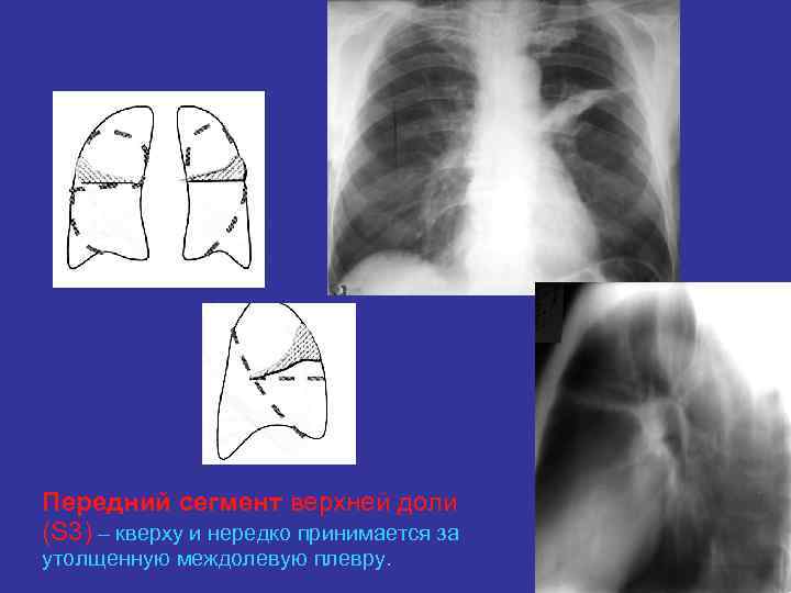 Уплотнение междолевой плевры