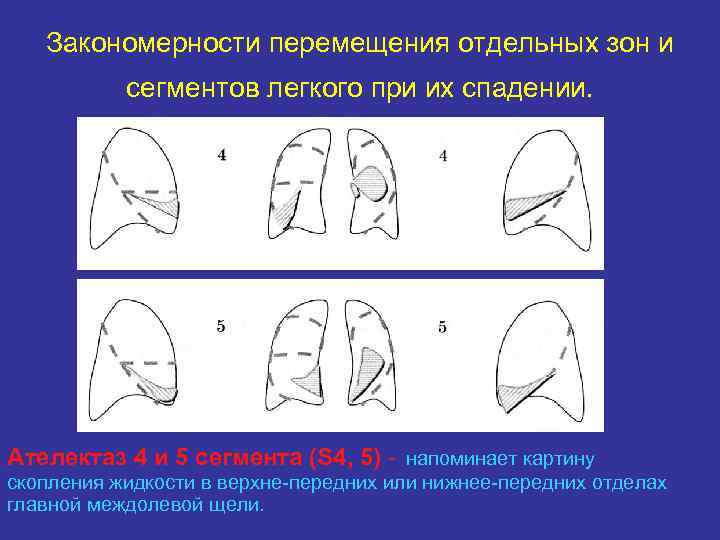 Ателектазы рентген схема