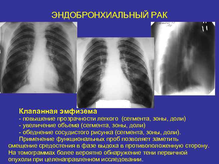 Обеднение сосудистого рисунка легких характерно для