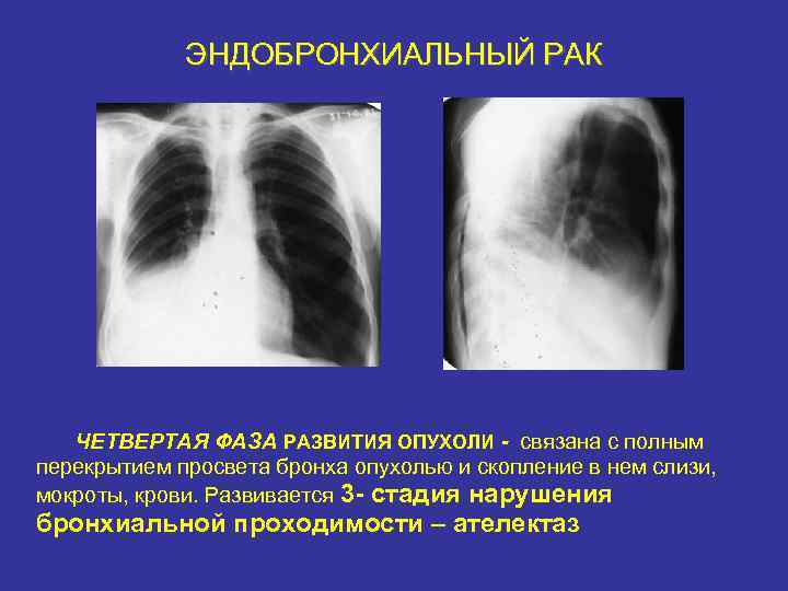 Ателектазы рентген схема