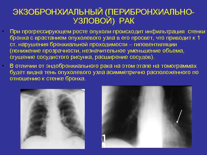 Лучевая картина центрального рака легкого