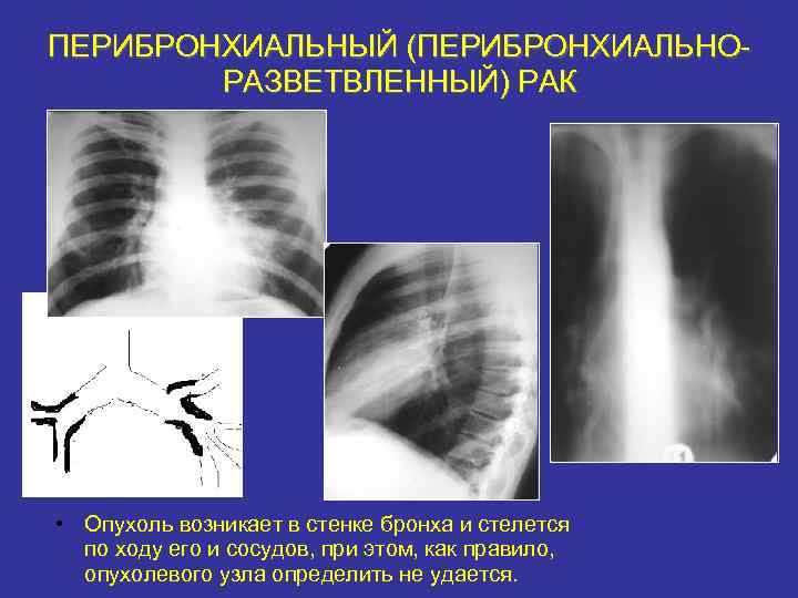 Легочный рисунок обогащен за счет перибронхиального компонента что это