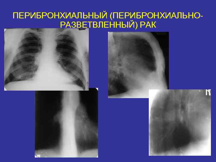 Легочный рисунок усилен перибронхиальным компонентом