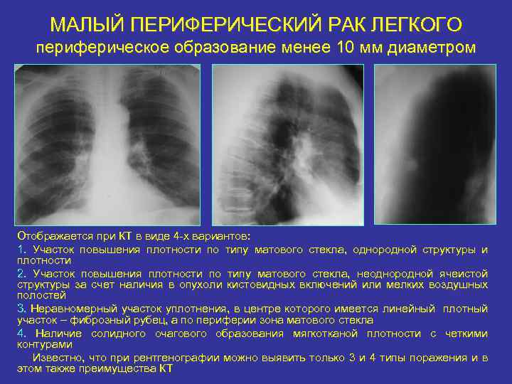 Что значат узелки в легких. Периферическое образование в легком. Периферическое образование в легких что это. Округлое образование в легком. Периферическое образование нижней доли правого легкого.